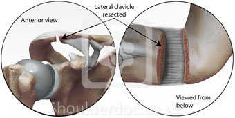 ACJ Excision ShoulderDoc